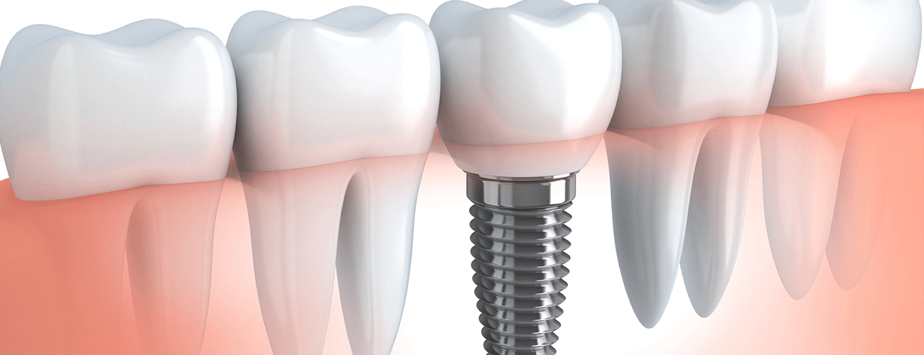 implant-dentar-buzau