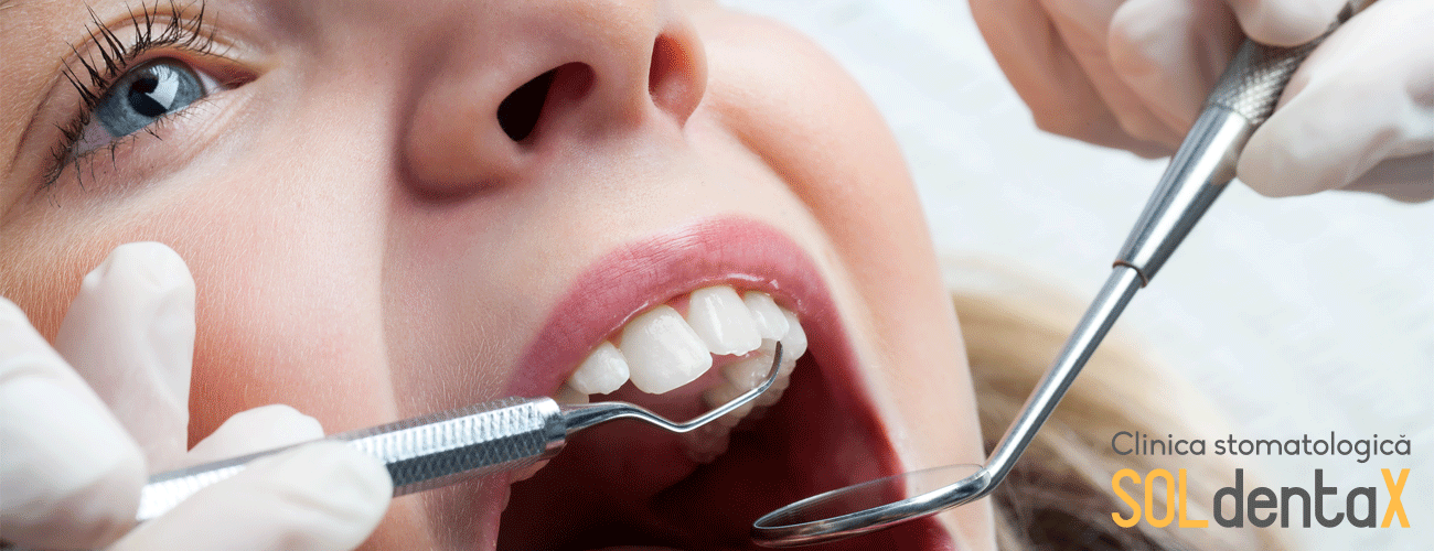 clinica-stomatologica-buzau-sigilarea-dentara