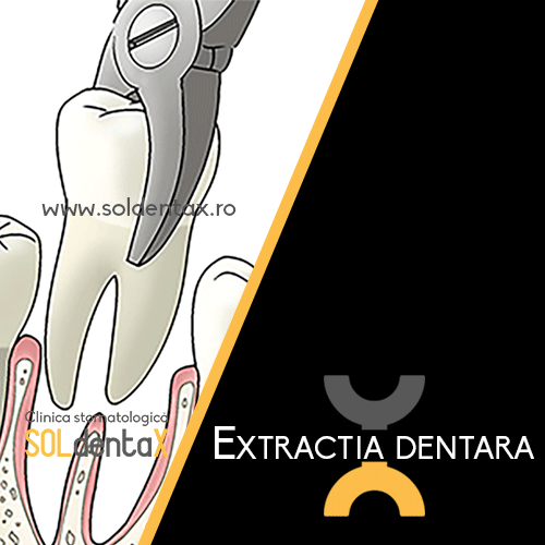 clinica-stomatologica-soldentax-buzau-extractia-dentara-blog-thumbnail