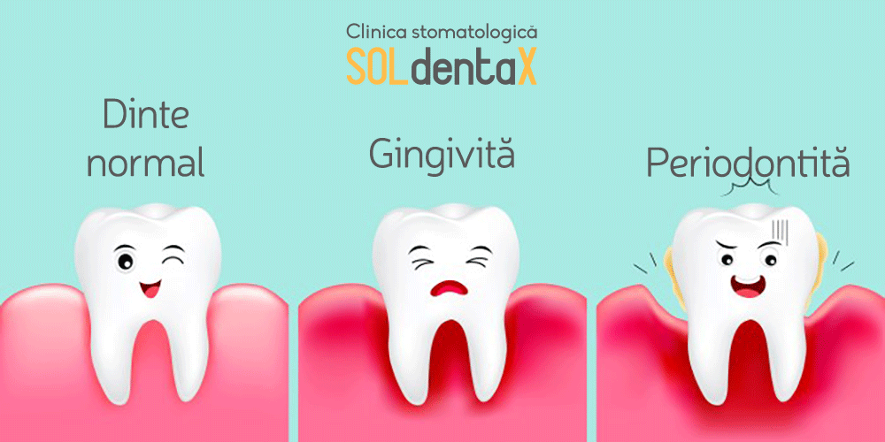 periodontita-clinica-stomatologica-soldentax-buzau-1