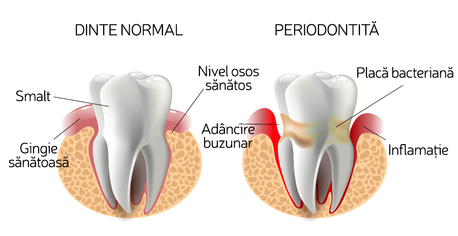 periodontita-clinica-stomatologica-soldentax-buzau-3