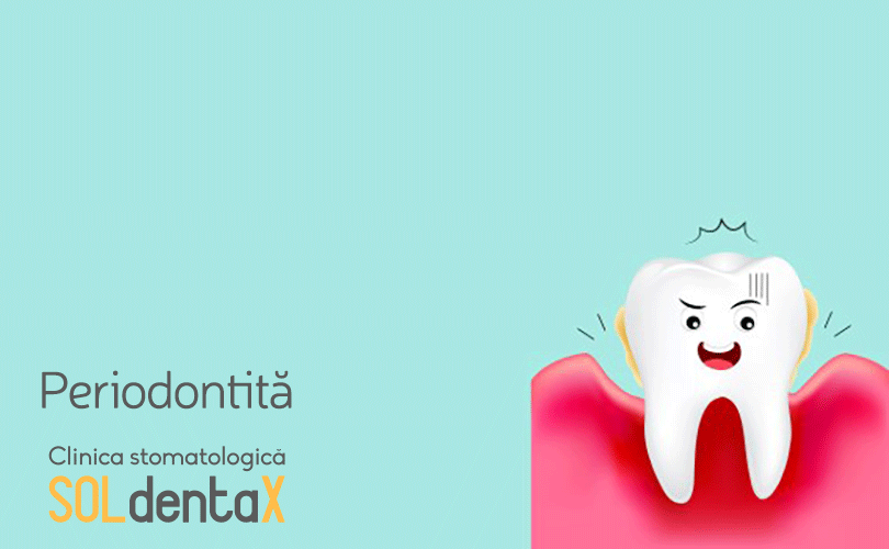 periodontita-clinica-stomatologica-soldentax-buzau-0